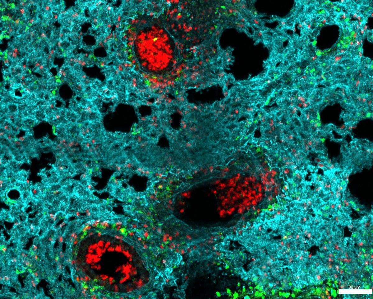 Neutrophil map: Creates a tool to fight cancer or diseases with a large number of immune cells |Hygi...