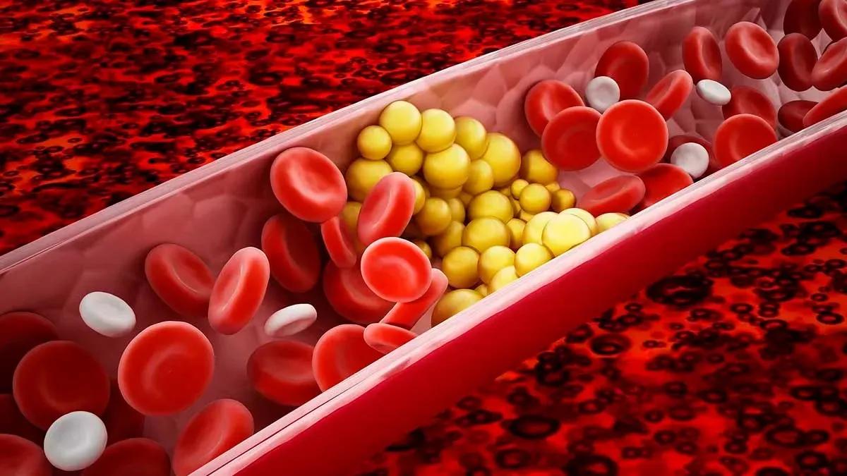 Atherosclerotic: Immadgerol Propicket, the purpose of the new promoter and treatment?